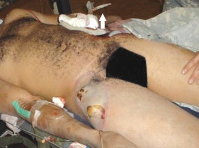 UXO pelvis 1.jpg